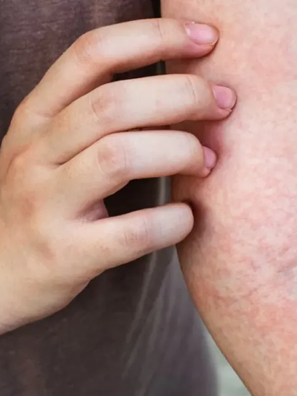 Eczema treatment in Tucson