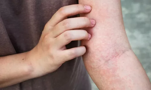 Eczema treatment